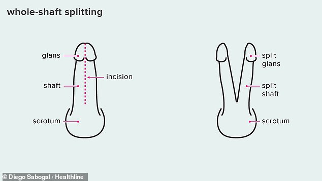 يوضح الرسم التوضيحي من موقع Healthline تقسيم العمود بالكامل، والذي يؤدي إلى قطع القضيب بالكامل إلى جزأين منفصلين.  ومن غير المعروف ما إذا كانت العيادة تقوم بذلك
